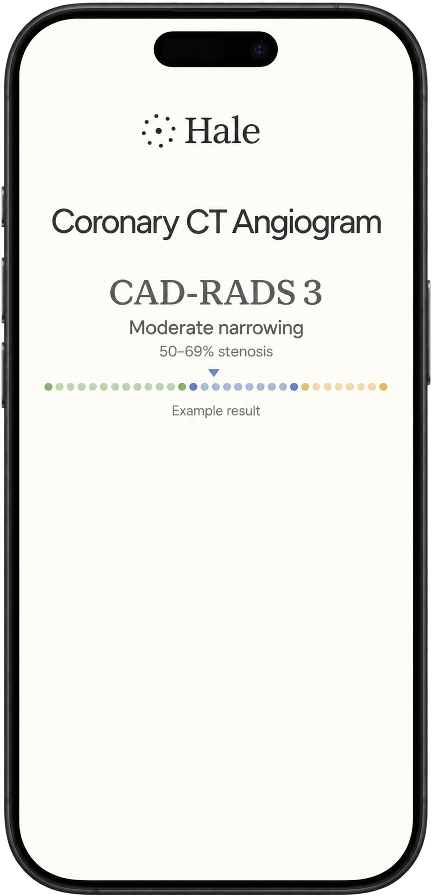 Example CCTA result: CAD-RADS 3, moderate narrowing with 50–69% stenosis
