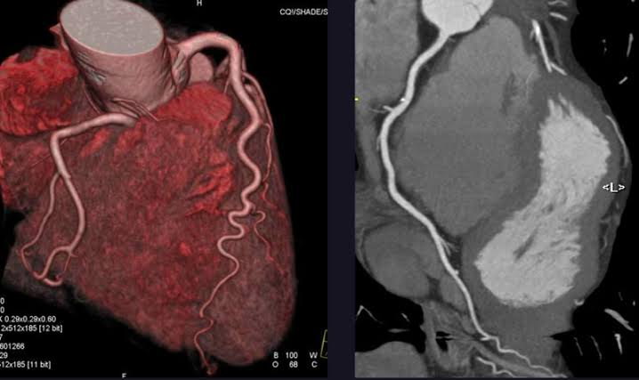 CCTA images showing a 3D view of the heart and a cross-sectional view of the coronary arteries